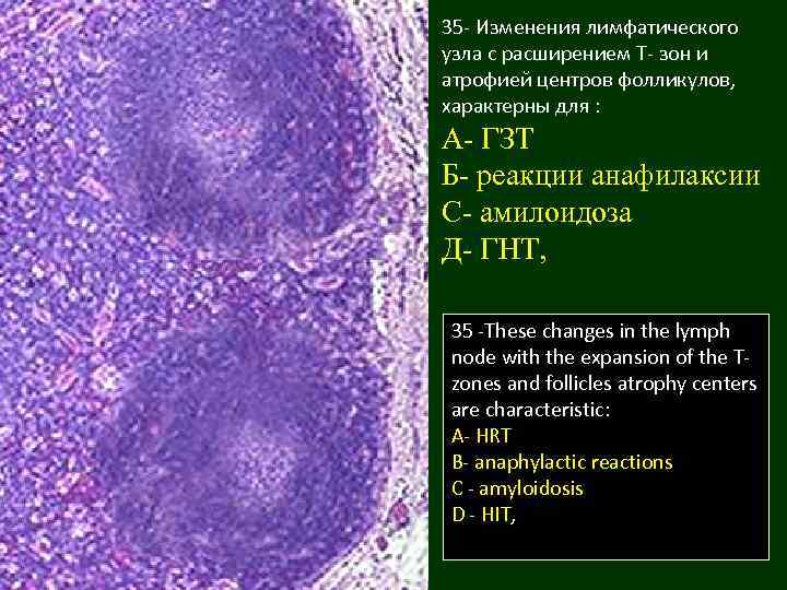 35 - Изменения лимфатического узла с расширением Т- зон и атрофией центров фолликулов, характерны