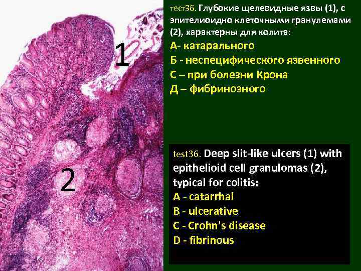 тест36. Глубокие щелевидные язвы (1), с 1 2 эпителиоидно клеточными гранулемами (2), характерны для