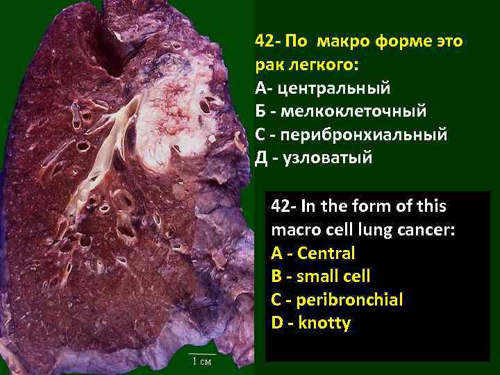 42 - По макро форме это рак легкого: А- центральный Б - мелкоклеточный С