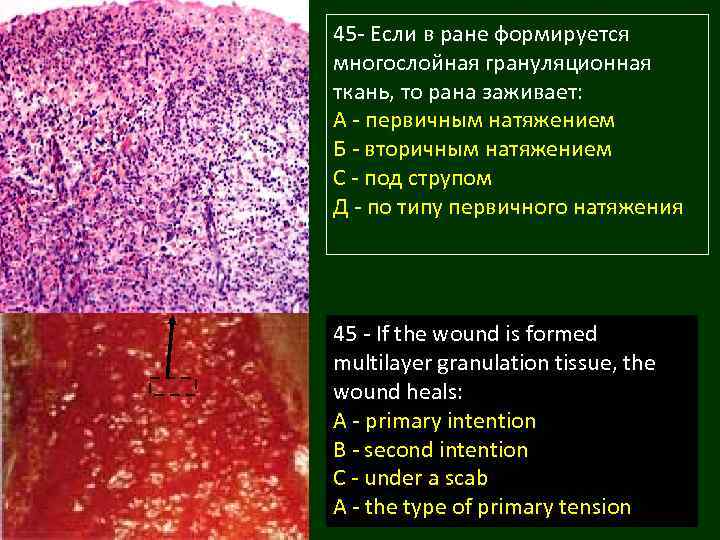 45 - Если в ране формируется многослойная грануляционная ткань, то рана заживает: А -