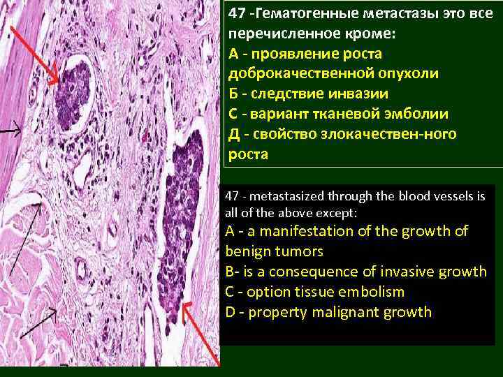 47 -Гематогенные метастазы это все перечисленное кроме: А - проявление роста доброкачественной опухоли Б