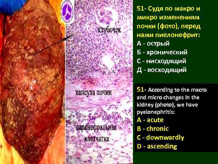 51 - Судя по макро и микро изменениям почки (фото), перед нами пиелонефрит: А