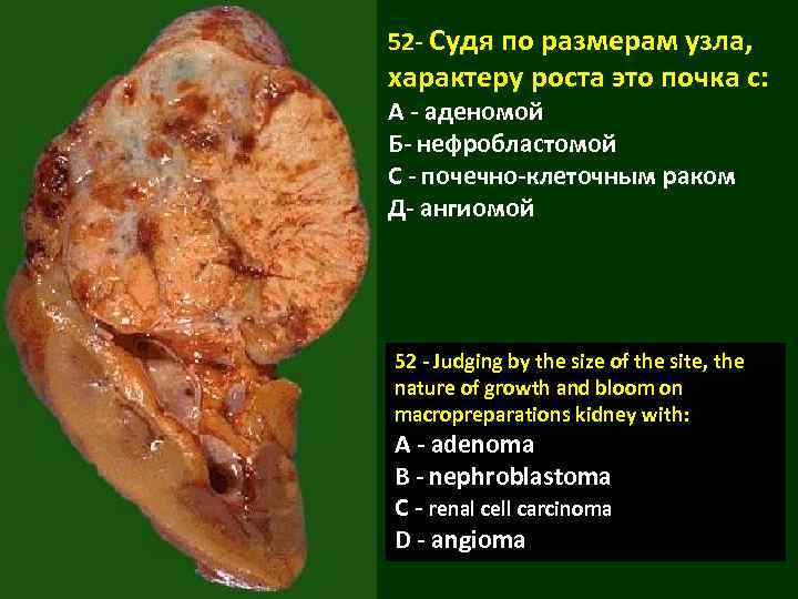 52 - Судя по размерам узла, характеру роста это почка с: А - аденомой