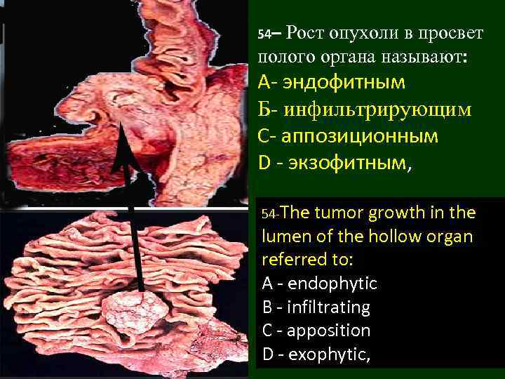 54– Рост опухоли в просвет полого органа называют: А- эндофитным Б- инфильтрирующим C- аппозиционным
