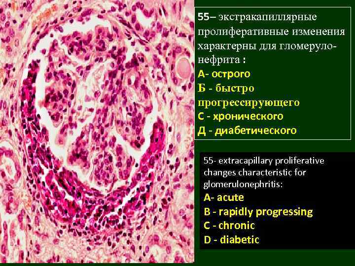 55– экстракапиллярные пролиферативные изменения характерны для гломерулонефрита : A- острого Б - быстро прогрессирующего