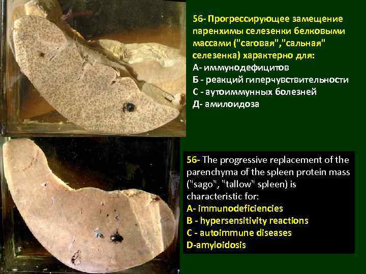 56 - Прогрессирующее замещение паренхимы селезенки белковыми массами (