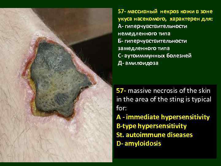 57 - массивный некроз кожи в зоне укуса насекомого, характерен для: А- гиперчувствительности немедленного