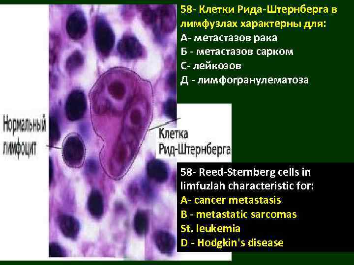 58 - Клетки Рида-Штернберга в лимфузлах характерны для: А- метастазов рака Б - метастазов
