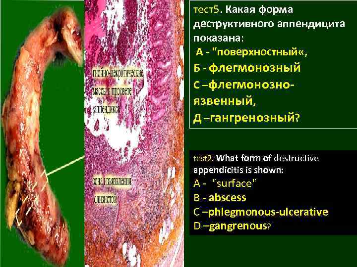 тест5. Какая форма деструктивного аппендицита показана: А - 