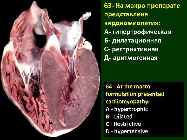 63 - На макро препарате представлена кардиомиопатия: А- гипертрофическая Б- дилатационная С- рестриктивная Д-