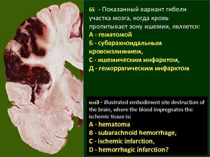 65 - Показанный вариант гибели участка мозга, когда кровь пропитывает зону ишемии, является: А