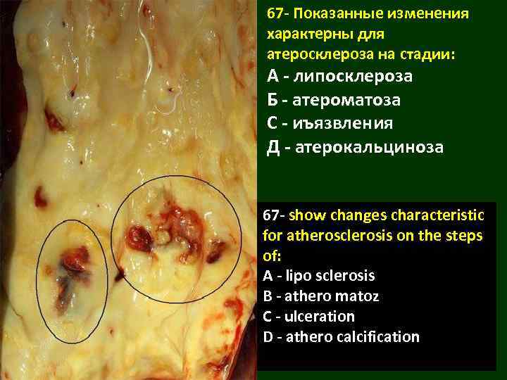 67 - Показанные изменения характерны для атеросклероза на стадии: А - липосклероза Б -