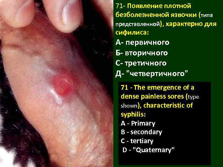 71 - Появление плотной безболезненной язвочки (типа представленной), характерно для сифилиса: А- первичного Б-