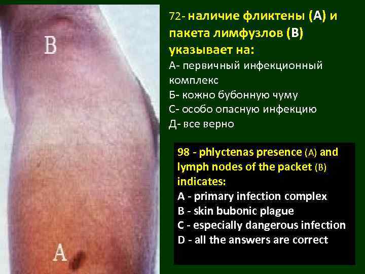 72 - наличие фликтены (А) и пакета лимфузлов (В) указывает на: А- первичный инфекционный