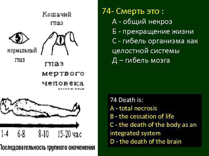 74 - Смерть это : А - общий некроз Б - прекращение жизни С