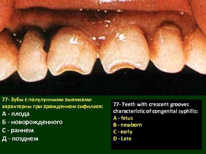 77 - Зубы с полулунными выемками характерны при врожденном сифилисе: А - плода Б