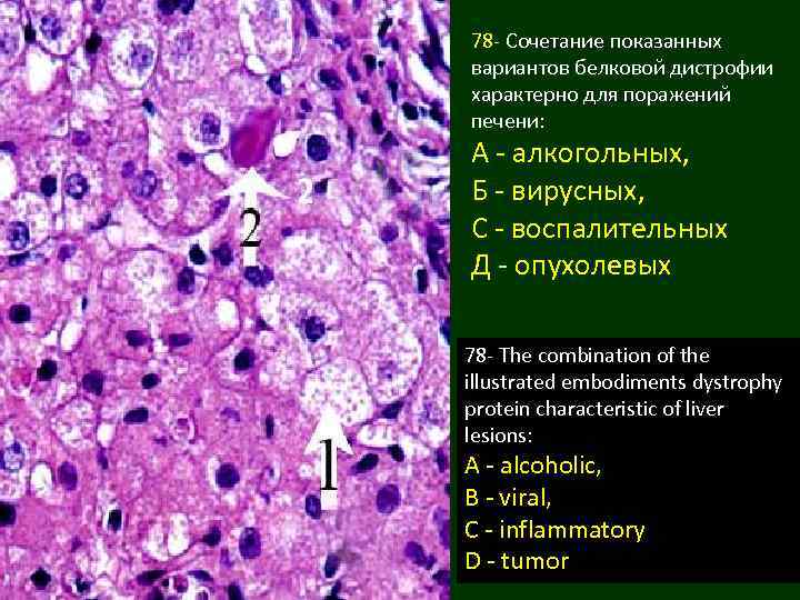 78 - Сочетание показанных вариантов белковой дистрофии характерно для поражений печени: А - алкогольных,