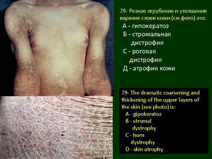 79 - Резкое огрубение и утолщение верхних слоев кожи (см. фото) это: А -