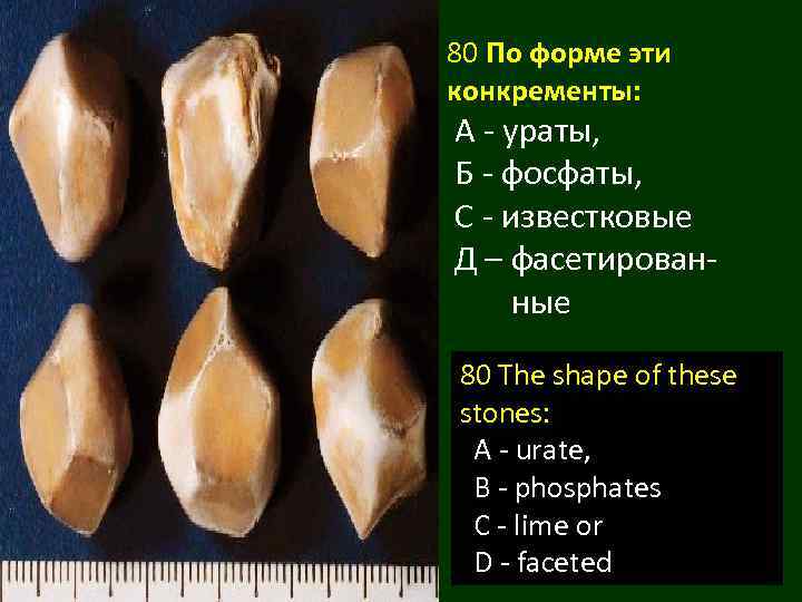 80 По форме эти конкременты: А - ураты, Б - фосфаты, С - известковые