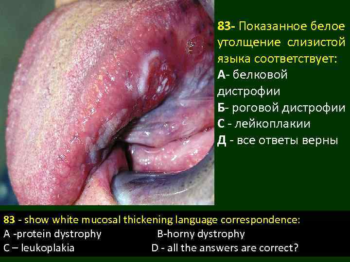 83 - Показанное белое утолщение слизистой языка соответствует: А- белковой дистрофии Б- роговой дистрофии