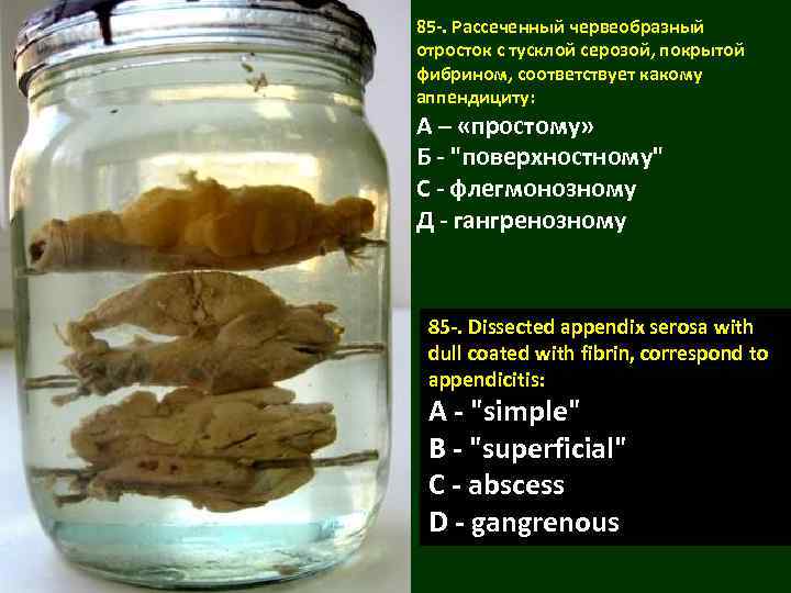 85 -. Рассеченный червеобразный отросток с тусклой серозой, покрытой фибрином, соответствует какому аппендициту: А
