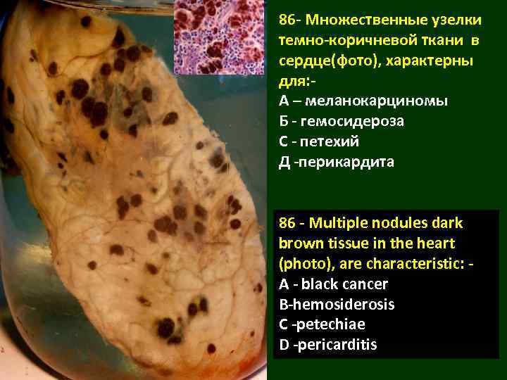 86 - Множественные узелки темно-коричневой ткани в сердце(фото), характерны для: А – меланокарциномы Б