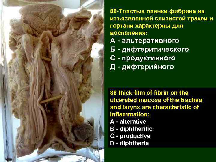 88 -Толстые пленки фибрина на изъязвленной слизистой трахеи и гортани характерны для воспаления: А