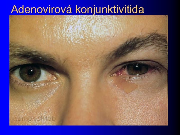 Adenovirová konjunktivitida 