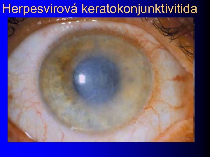 Herpesvirová keratokonjunktivitida 