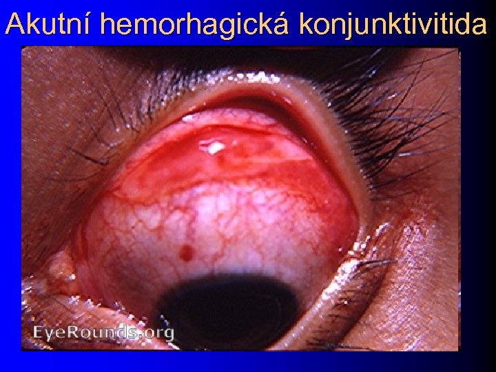 Akutní hemorhagická konjunktivitida 