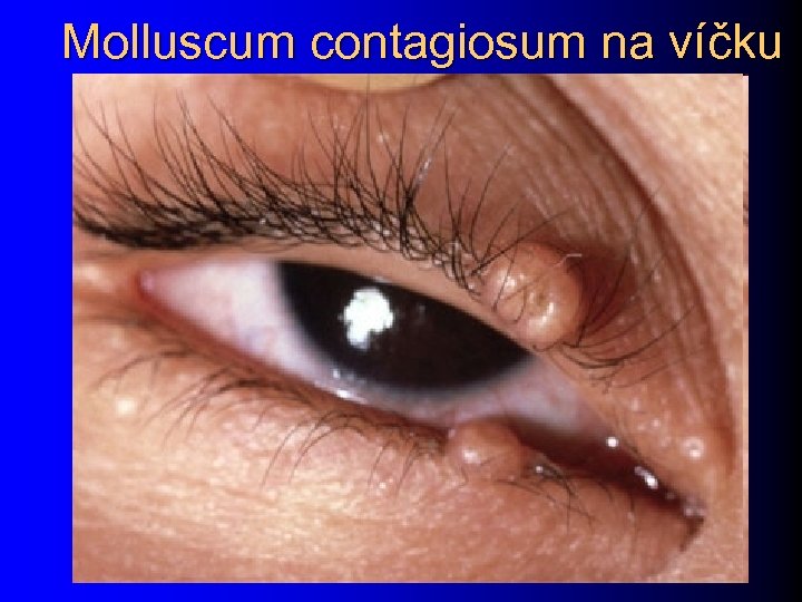 Molluscum contagiosum na víčku 