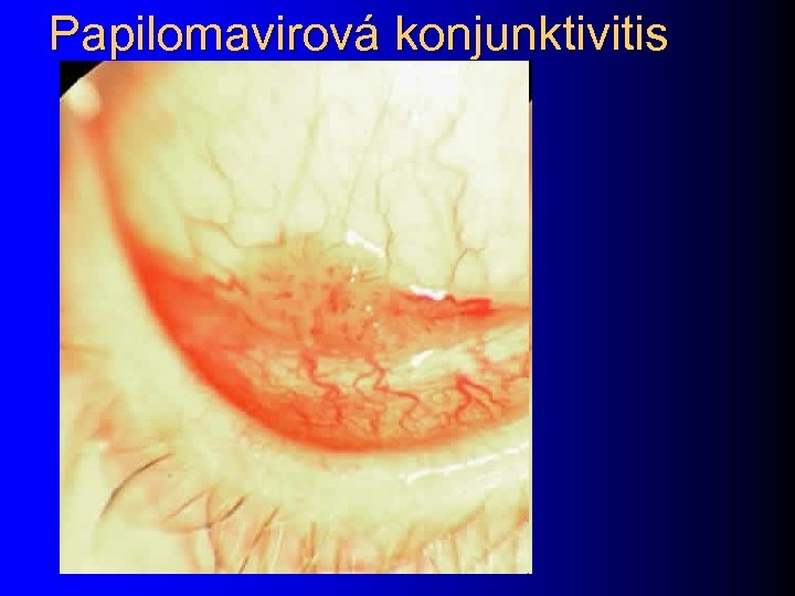 Papilomavirová konjunktivitis 