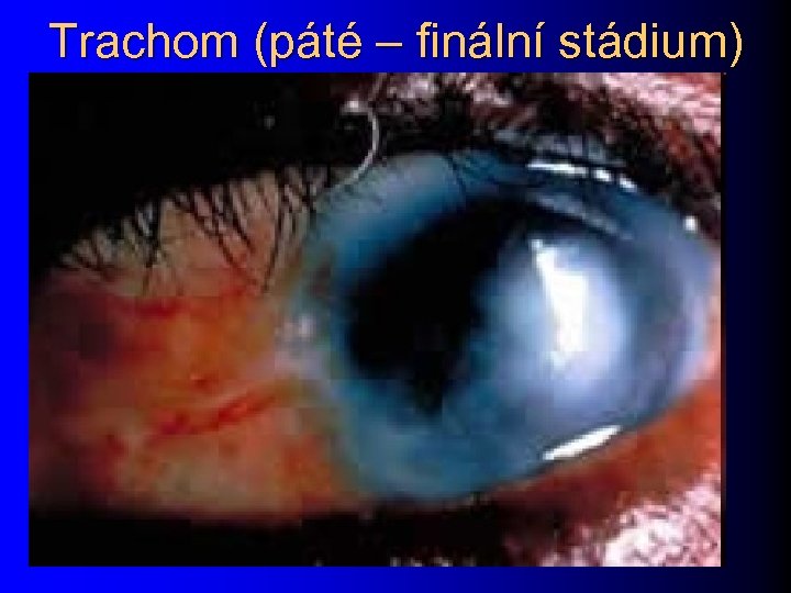 Trachom (páté – finální stádium) 