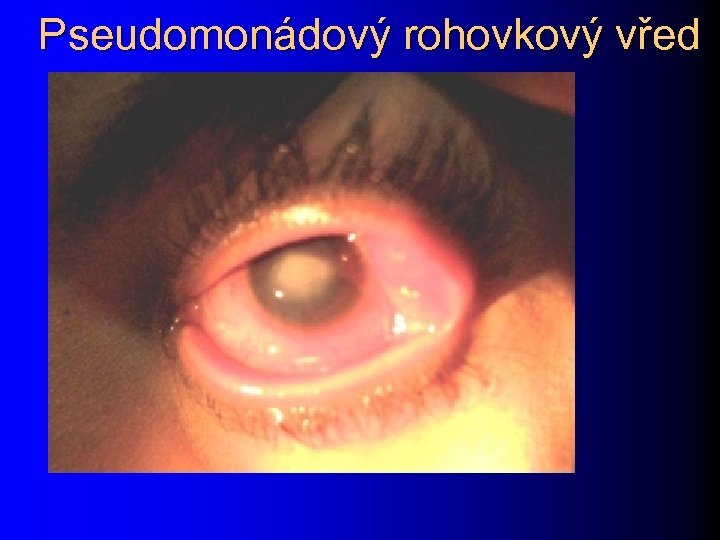 Pseudomonádový rohovkový vřed 