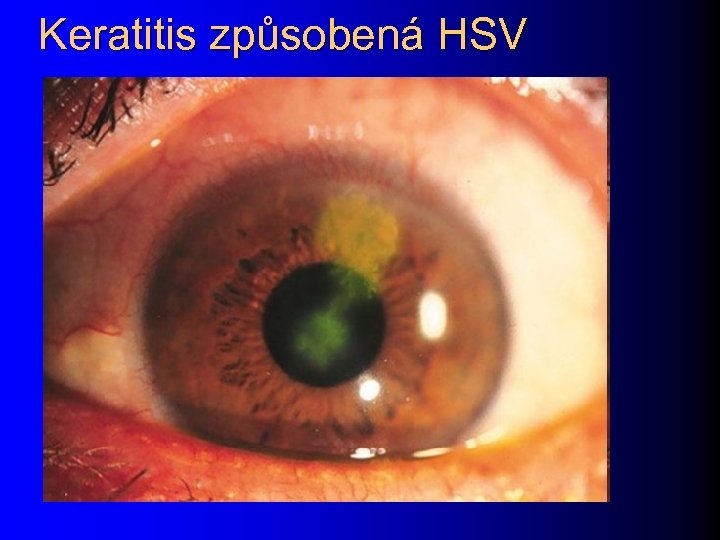 Keratitis způsobená HSV 