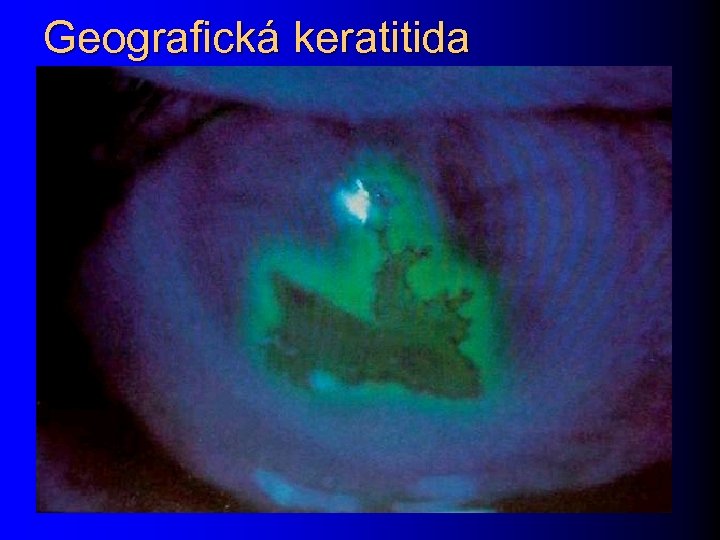 Geografická keratitida 