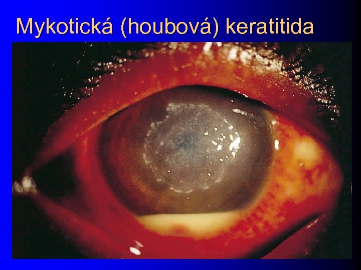 Mykotická (houbová) keratitida 