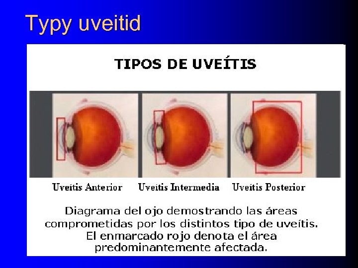 Typy uveitid 
