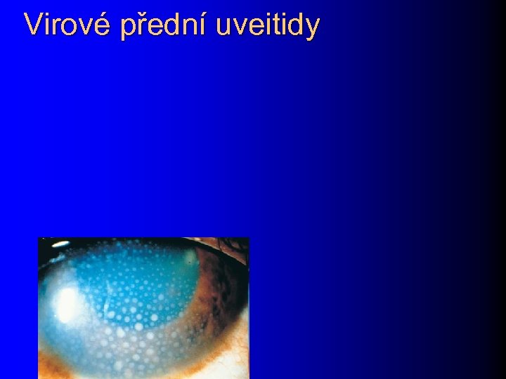 Virové přední uveitidy 