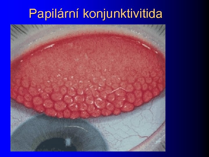 Papilární konjunktivitida 