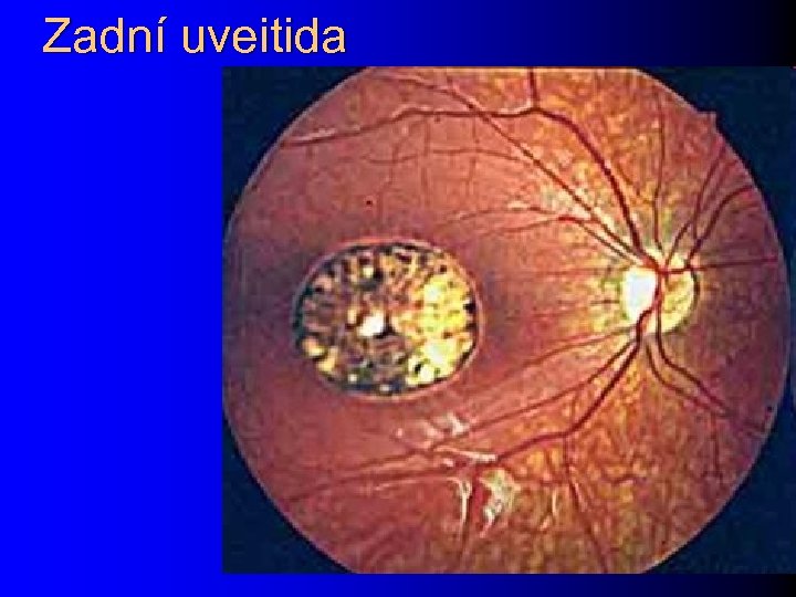 Zadní uveitida 