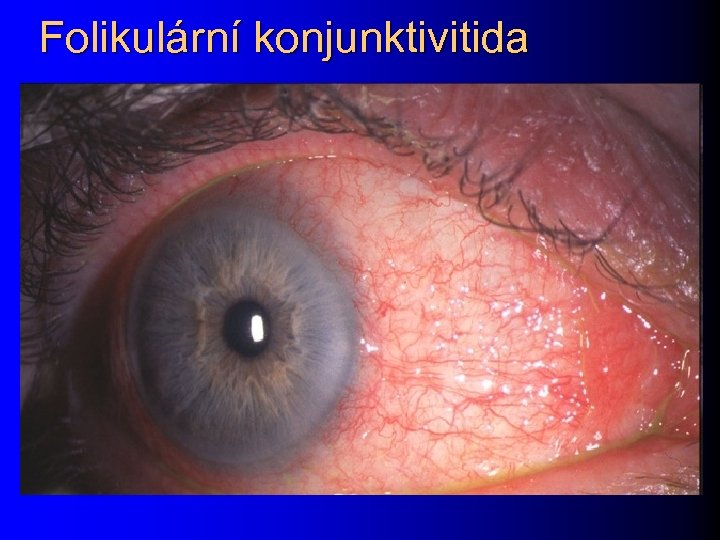 Folikulární konjunktivitida 