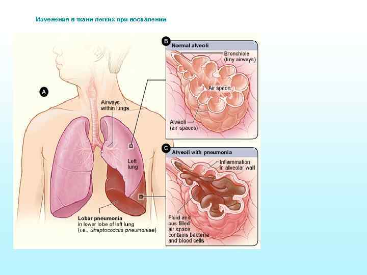 Изменения в ткани легких при воспалении 
