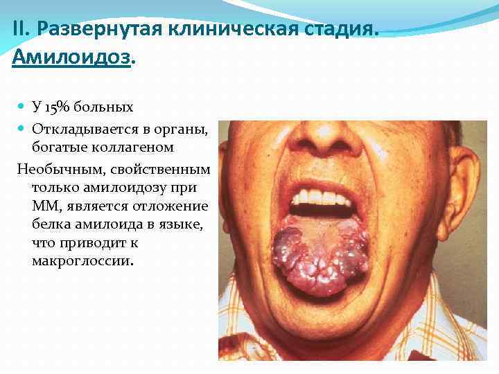 II. Развернутая клиническая стадия. Амилоидоз. У 15% больных Откладывается в органы, богатые коллагеном Необычным,