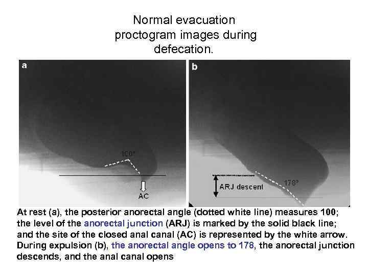 Normal evacuation proctogram images during defecation. At rest (a), the posterior anorectal angle (dotted