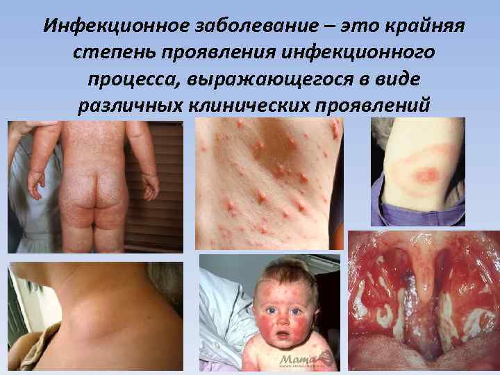 Инфекционное заболевание – это крайняя степень проявления инфекционного процесса, выражающегося в виде различных клинических