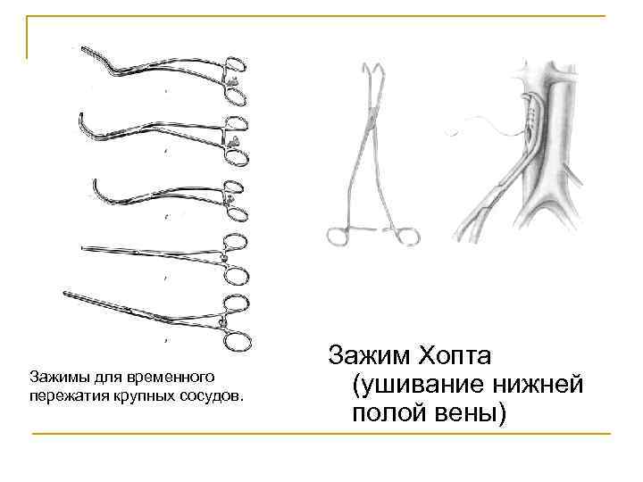 Зажимы для временного пережатия крупных сосудов. Зажим Хопта (ушивание нижней полой вены) 