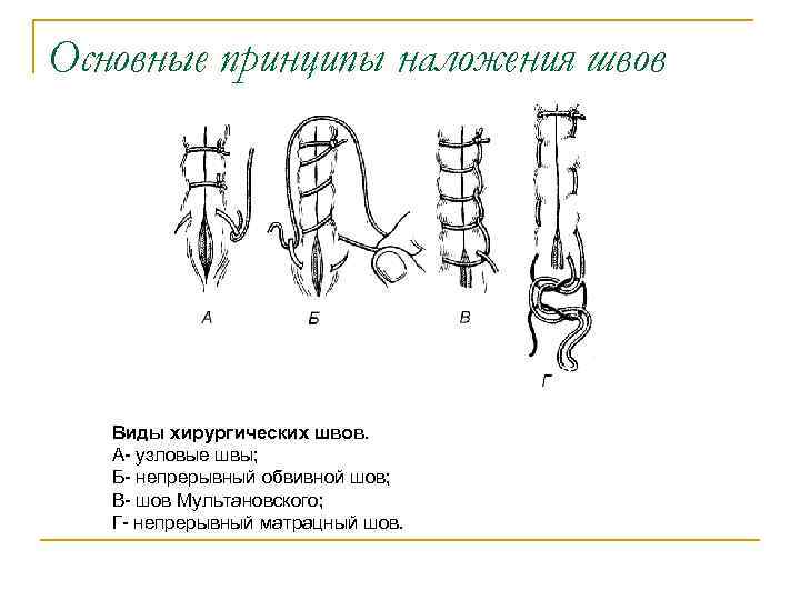 Виды хирургических швов презентация