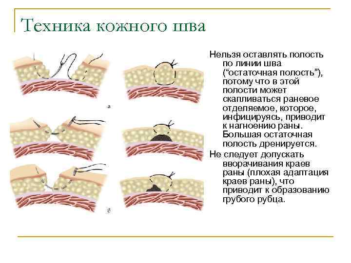 Швы в хирургии презентация