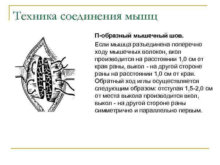 Техника соединения мышц П-образный мышечный шов. Если мышца разъединена поперечно ходу мышечных волокон, вкол